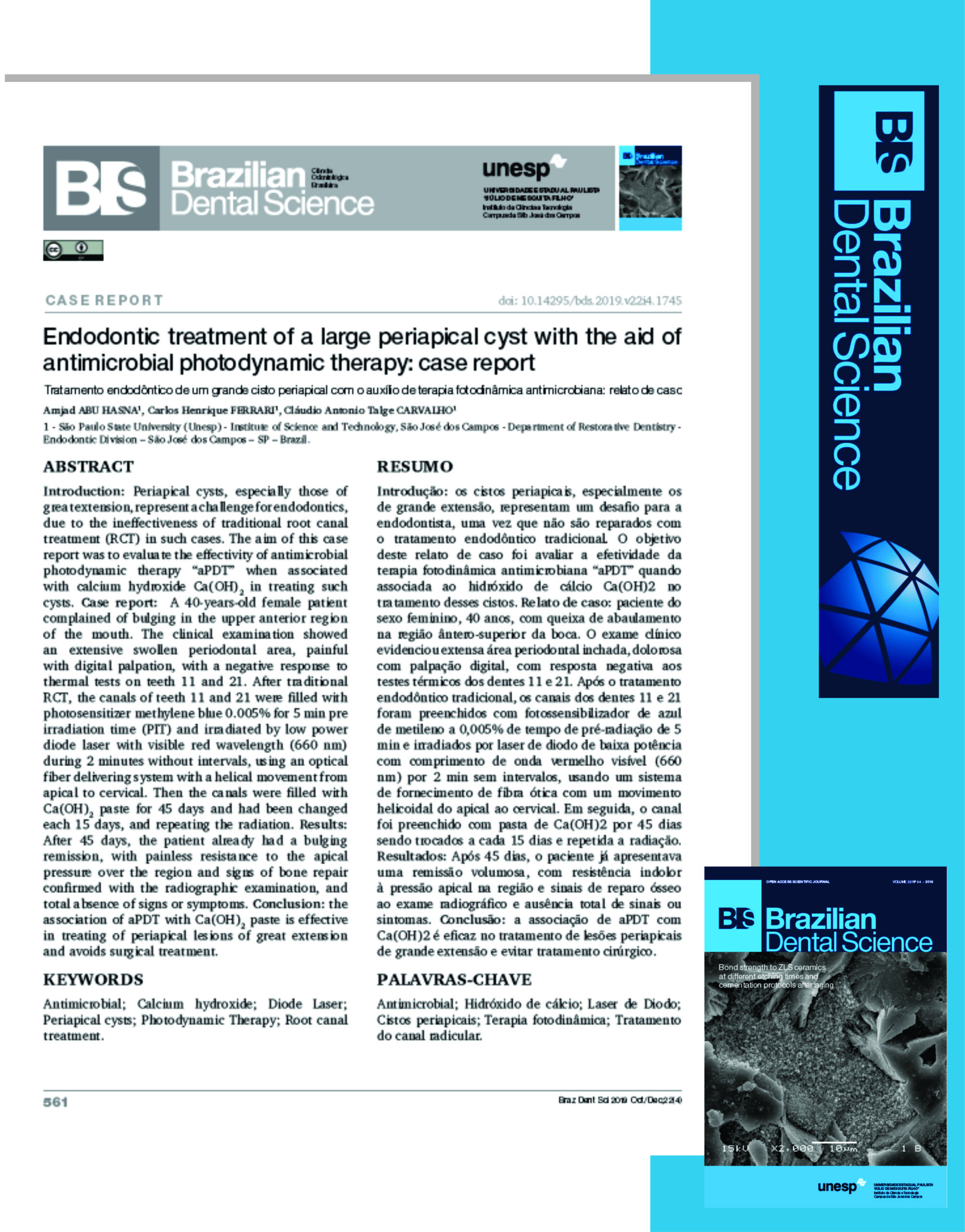 You are currently viewing Cisto periapical. Endodontic treatment of a large periapical cyst with the aid of antimicrobial photodynamic therapy: case report