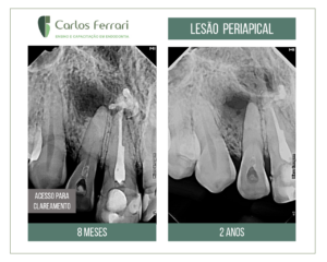 Read more about the article Conservative endodontic treatment in a case with extensive periapical lesion