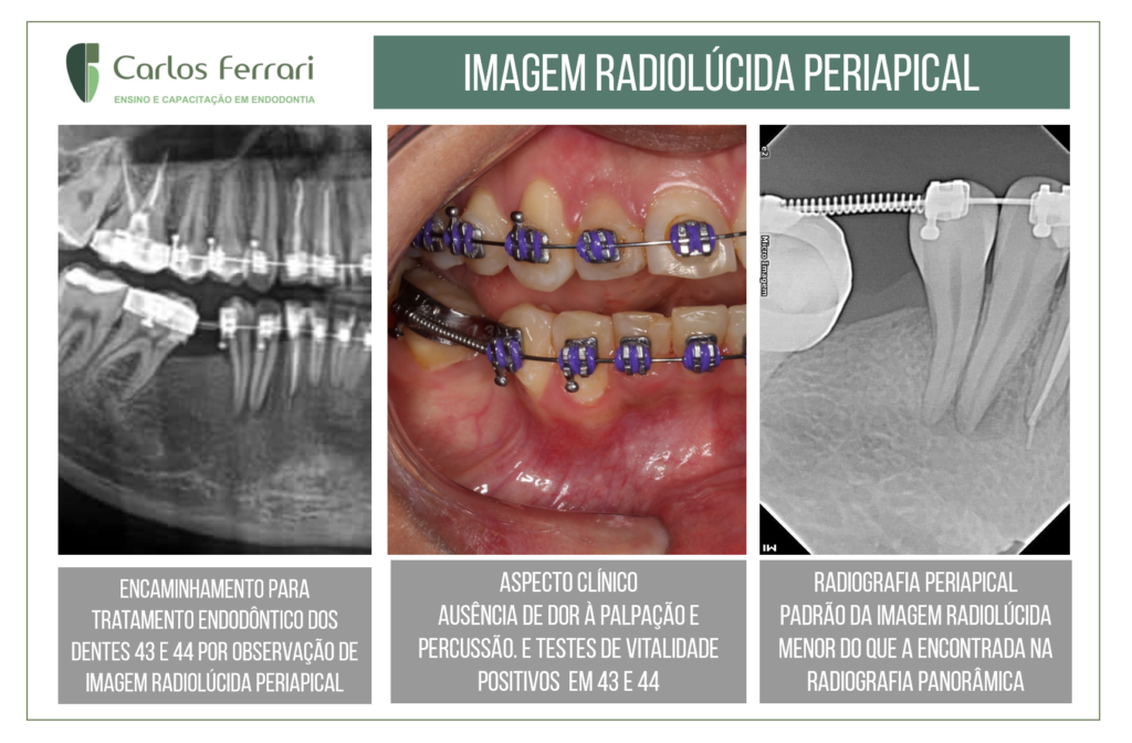 Leer más sobre el artículo Imagen radiolúcida en un paciente bajo tratamiento de ortodoncia. Falsa lesión periapical.