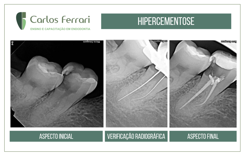 Read more about the article Endodontic treatment and hypercementosis