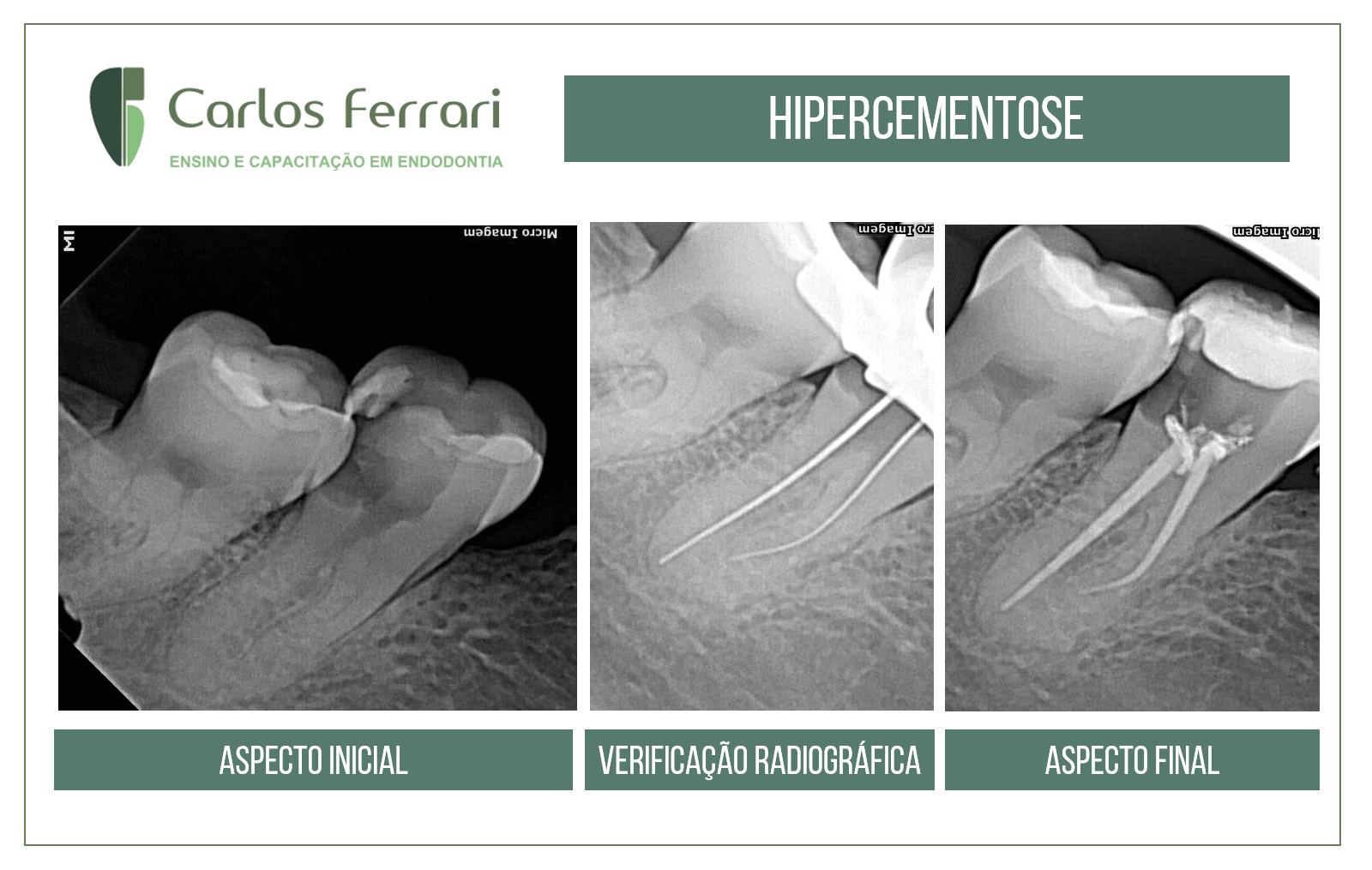 You are currently viewing Endodontic treatment and hypercementosis