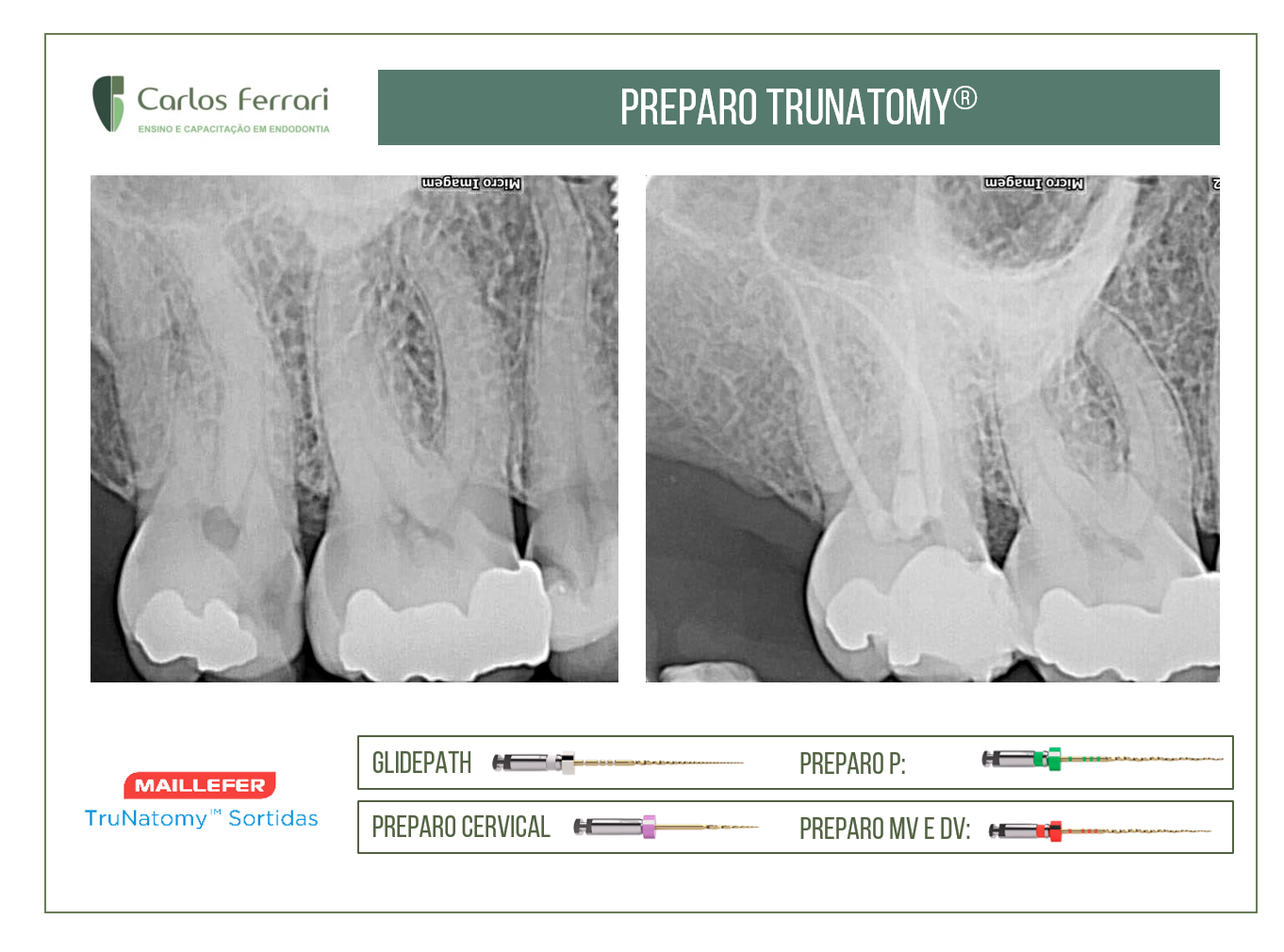 You are currently viewing Endodontic preparation with the Trunatomy system