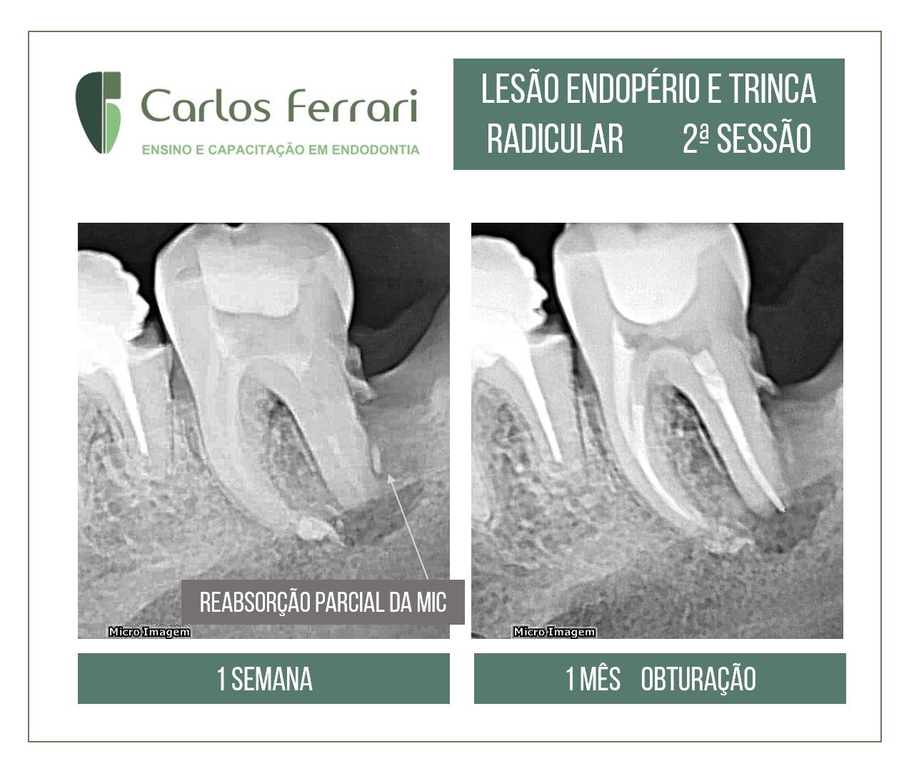 You are currently viewing Lesão endoperio. Molar inferior com pulpite.