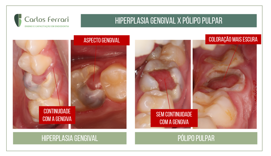 Read more about the article Pólipo pulpar ou hiperplasia gengival