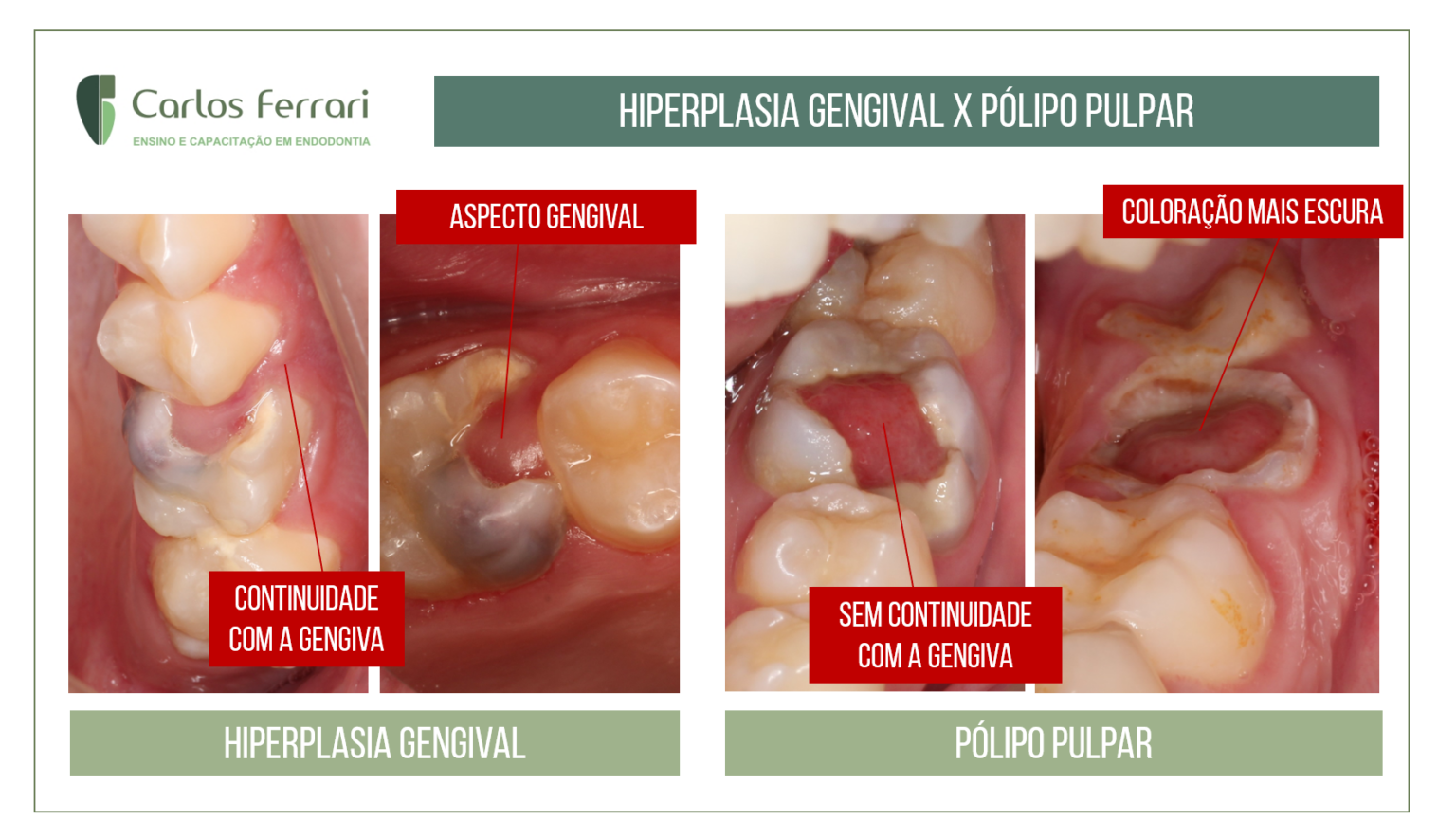 Pólipo pulpar ou hiperplasia gengival Instituto Carlos Ferrari de Endodontia