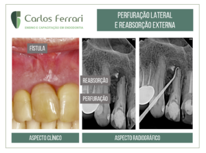 Read more about the article Root perforation and external root resorption.