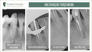 Read more about the article Lima manual em calcificação do canal radicular no terço médio.