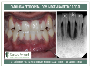 Read more about the article Lesão  periapical sem origem endodôntica.