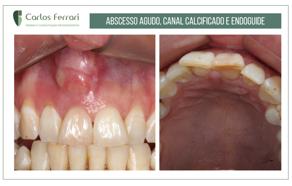 Read more about the article Abscesso periapical agudo e canal calcificado.