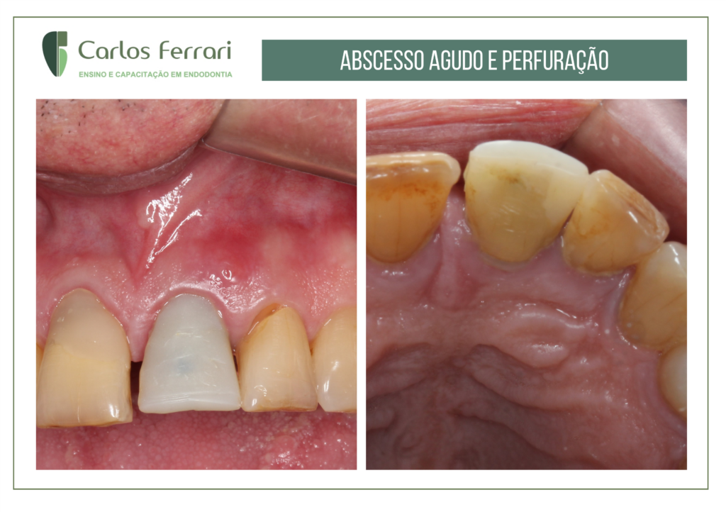 Read more about the article Perfuração radicular tratada com cirurgia paraendodôntica