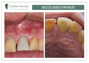 Read more about the article Perfuração radicular tratada com cirurgia paraendodôntica