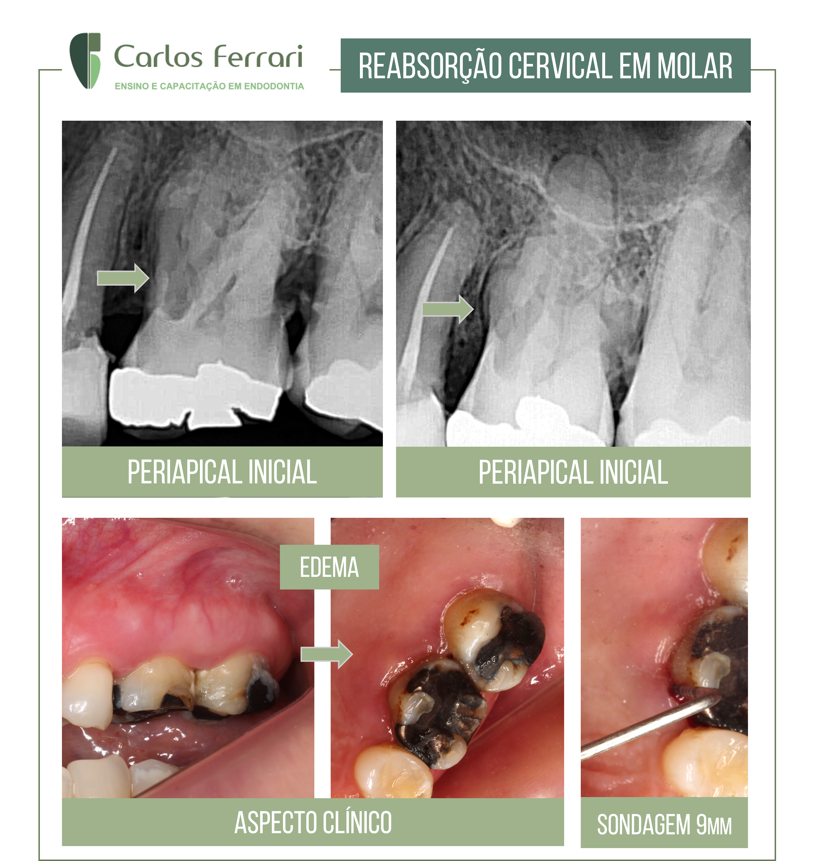 You are currently viewing Intentional reimplantation in a molar with root resorption.