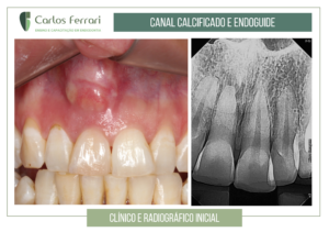 Read more about the article Endoguide em canal calcificado