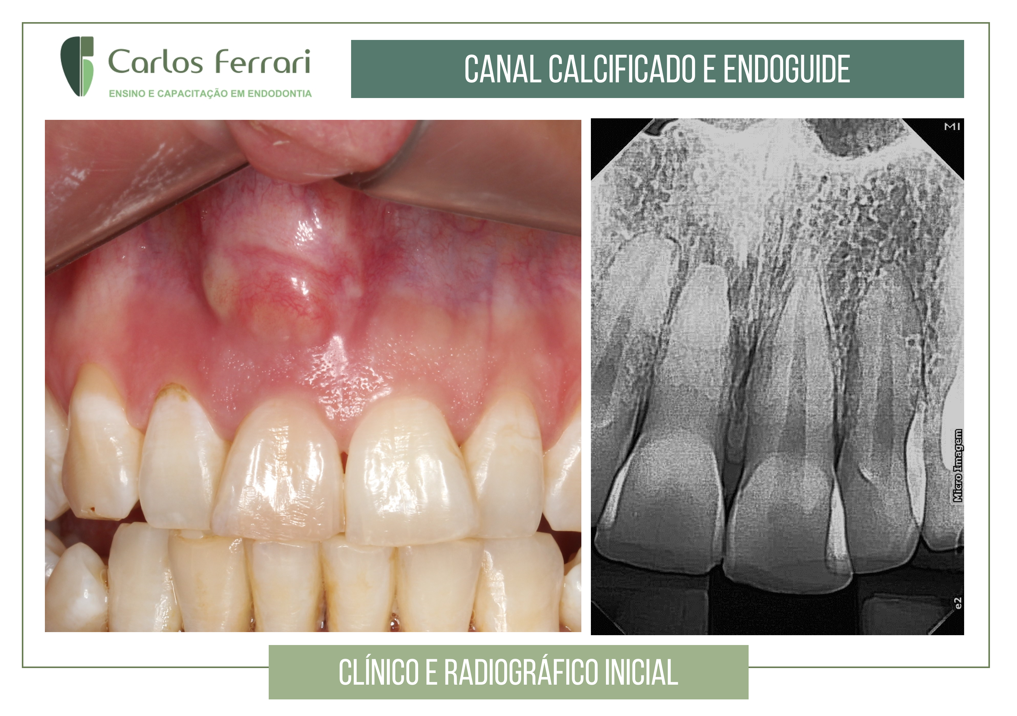 You are currently viewing Endoguide in calcified canal