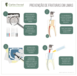Read more about the article Fratura de lima endodôntica. Guia de prevenção de .