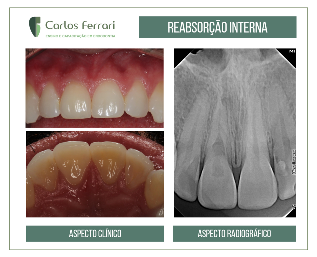 Read more about the article Internal root resorption
