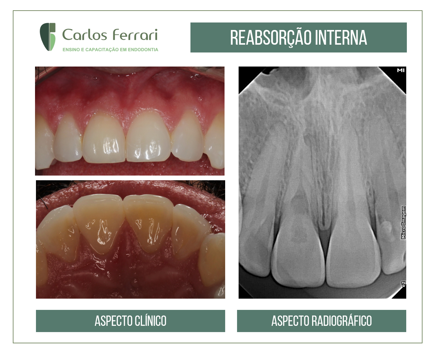 You are currently viewing Internal root resorption