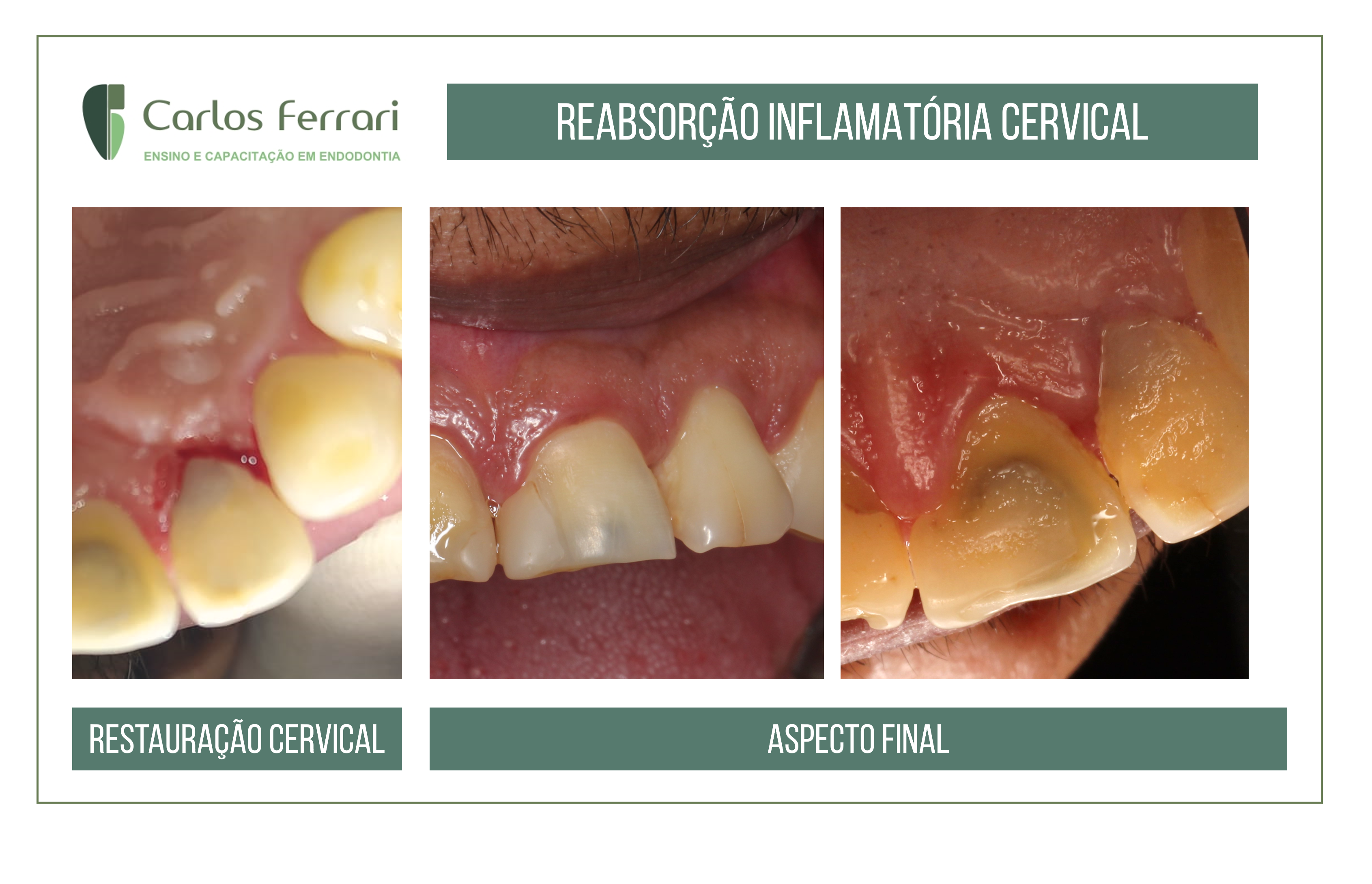 You are currently viewing External Cervical Resorption. Endodontic and surgical treatment.