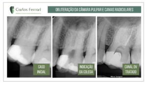 Read more about the article Canal calcificado em molar superior.