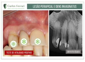 Read more about the article Lesão periapical e dens invaginatus.