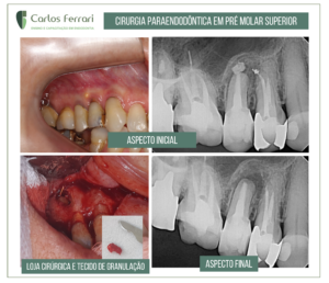 Read more about the article Cirurgia paraendodôntica