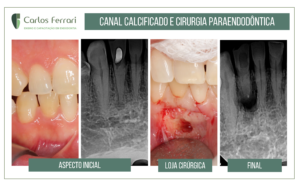 Read more about the article Endodontic surgery in calcified root canal.
