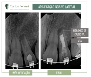 Read more about the article Apicificação em dente com rizogênese incompleta.