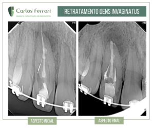 Read more about the article Retreatment of dens invaginatus with MTA. Endodontics.