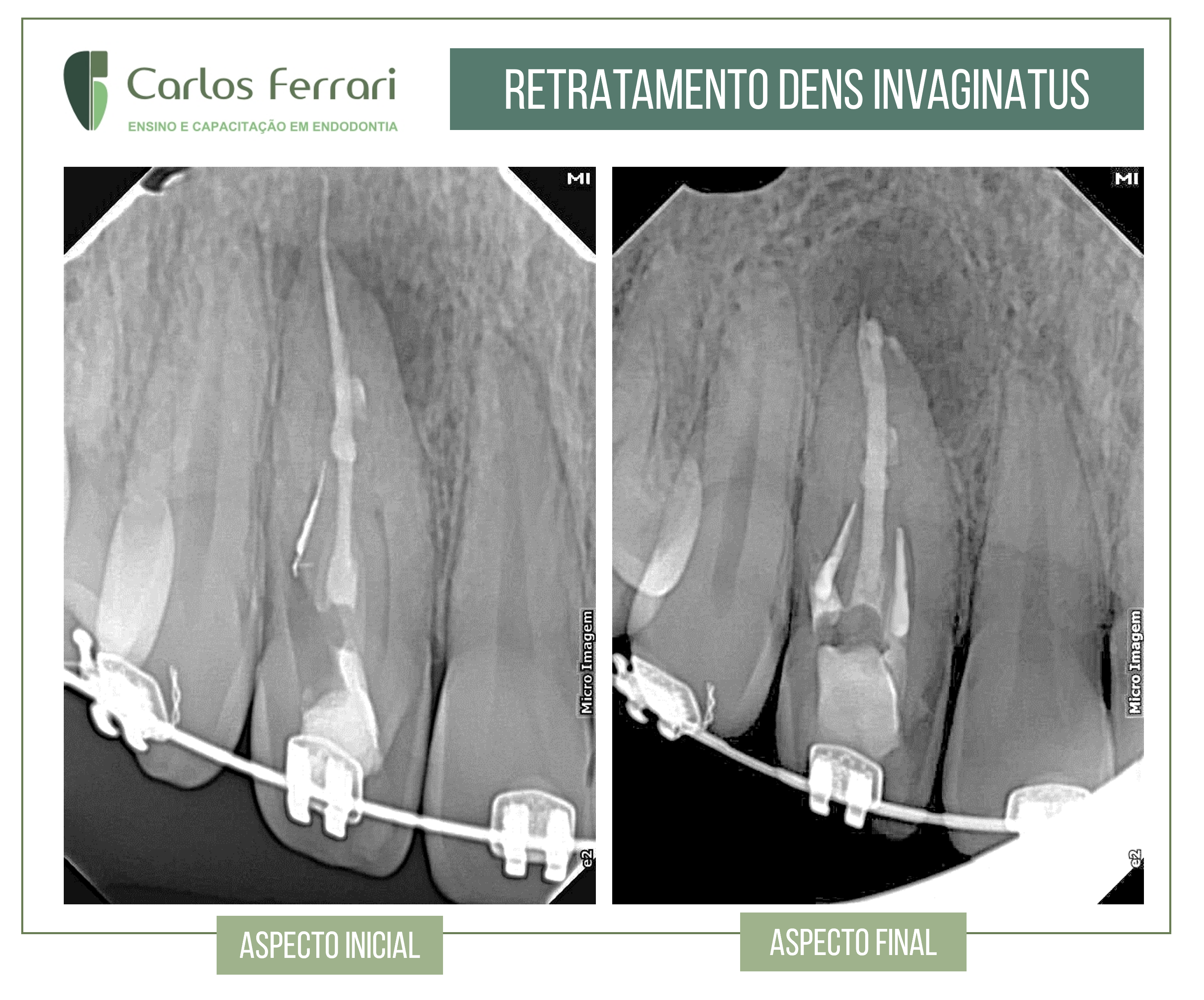 You are currently viewing Retreatment of dens invaginatus with MTA. Endodontics.