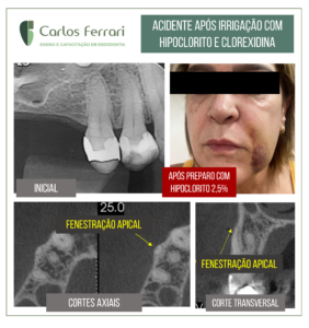 Read more about the article Irrigação na endodontia. Acidente com hipoclorito e clorexidina.