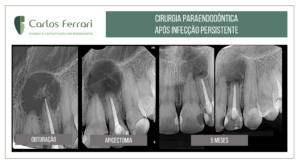 Leer más sobre el artículo Cirugía endodóntica tras infección persistente en un diente con lesión periapical.
