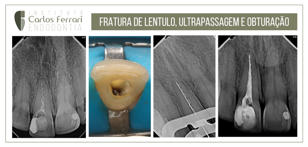 Read more about the article Fratura de lentulo, ultrapassagem e obturação.