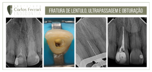 Read more about the article Lentule fracture, bridging and obturation.