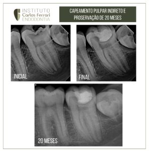 了解更多有关文章 在不完全根瘤发生过程中使用生物陶瓷直接保护牙髓的信息。