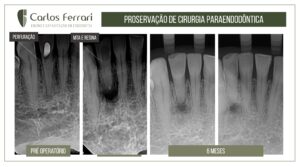 Read more about the article Cirurgia paraendodôntica. Proservação após 6 meses.