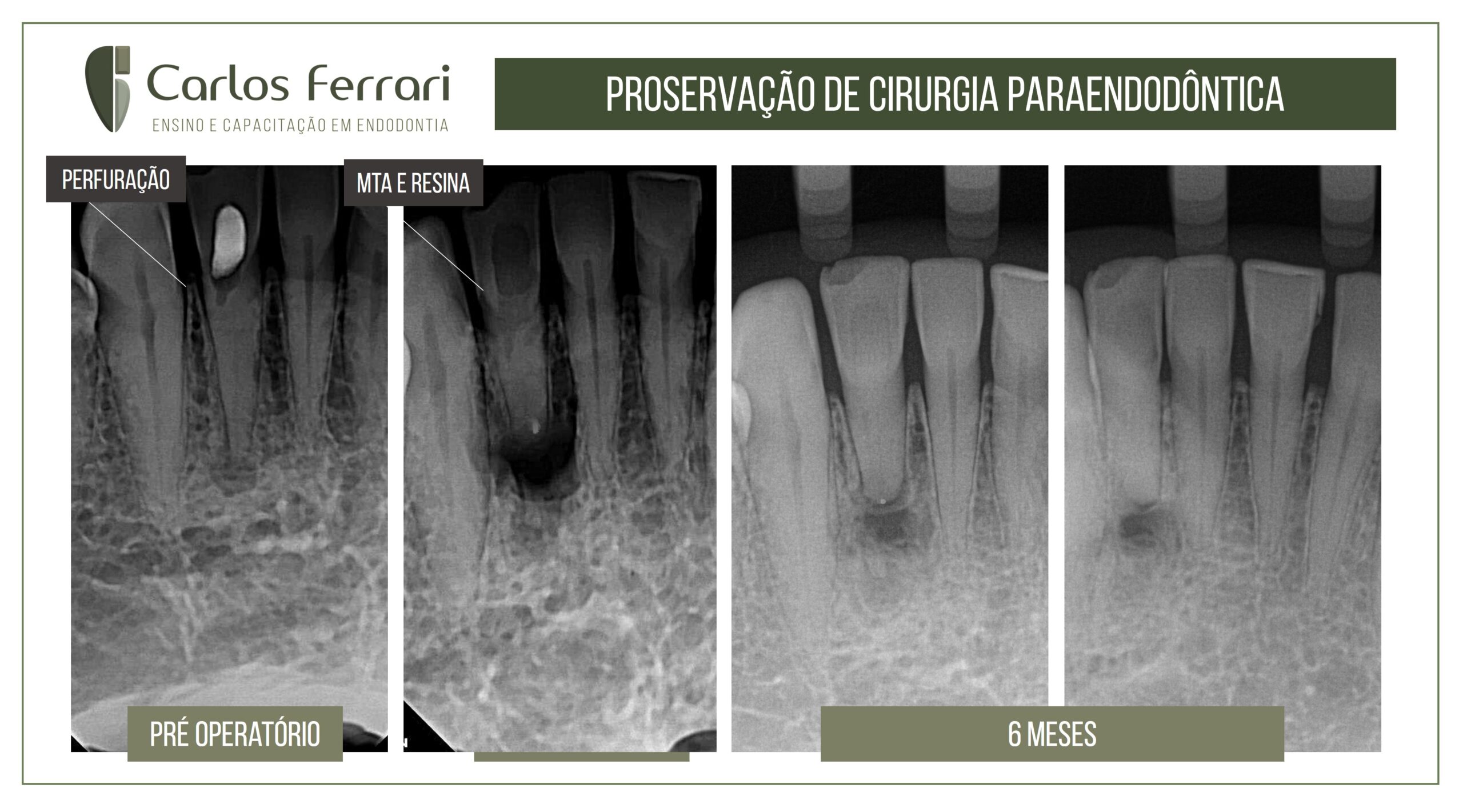 You are currently viewing Cirurgia paraendodôntica. Proservação após 6 meses.