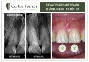 Read more about the article Forame incisivo e lesão periapical. Relato de caso.
