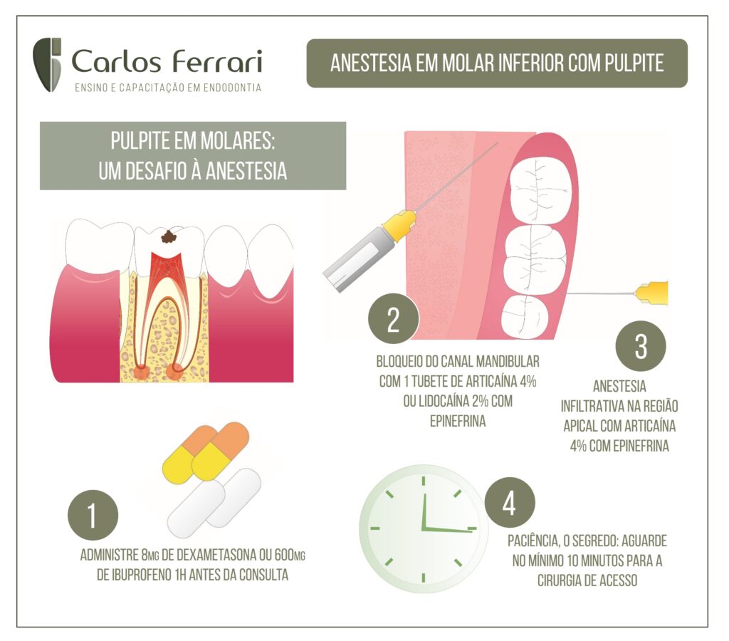 Read more about the article Anestesia odontológica. Anestesia em pulpite de molares.