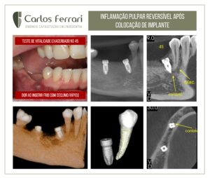 Read more about the article Reversible pulp inflammation after implant placement.