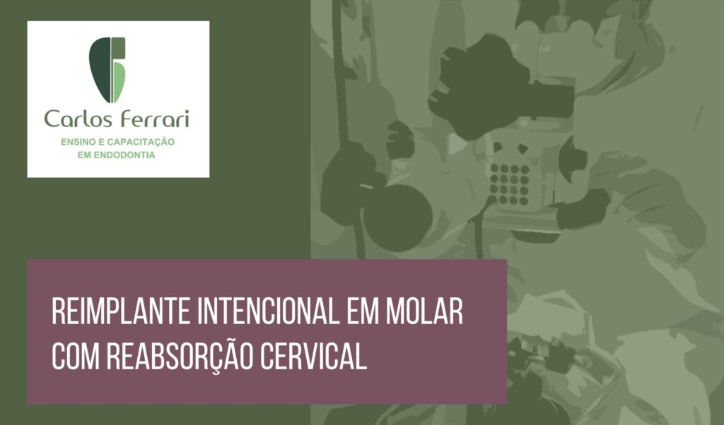 Read more about the article Reabsorção radicular. Reimplante Intencional em reabsorção cervical.