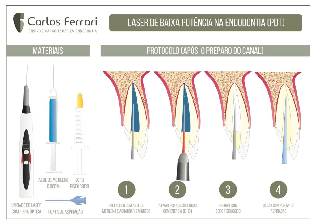 Read more about the article Terapia fotodinâmica na endodontia. Guia de utilização.