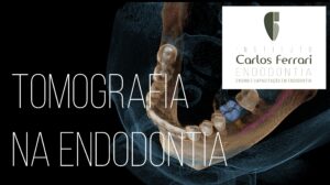 Read more about the article Tomografia na endodontia. Introdução. Aula online.