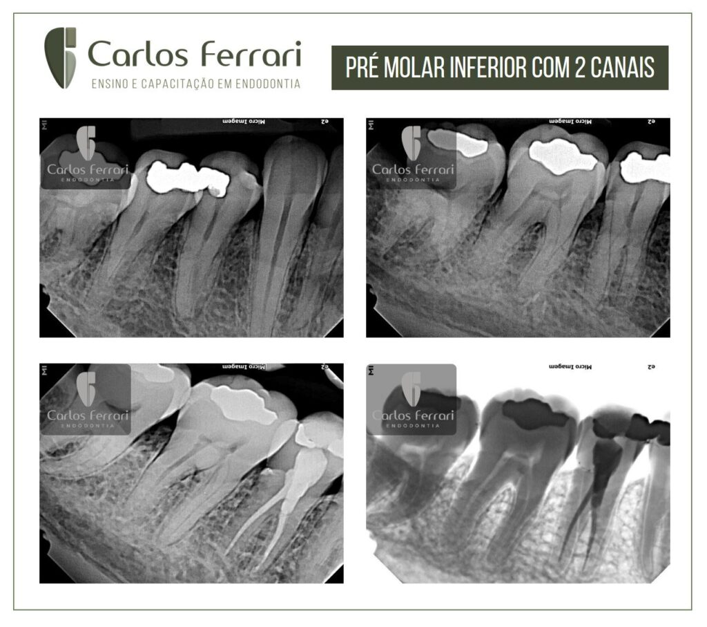 阅读更多关于文章 Premolar lower.用两根牙管治疗45号牙。