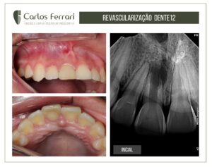 阅读更多关于文章 牙髓血管再造术。成年患者的病例。