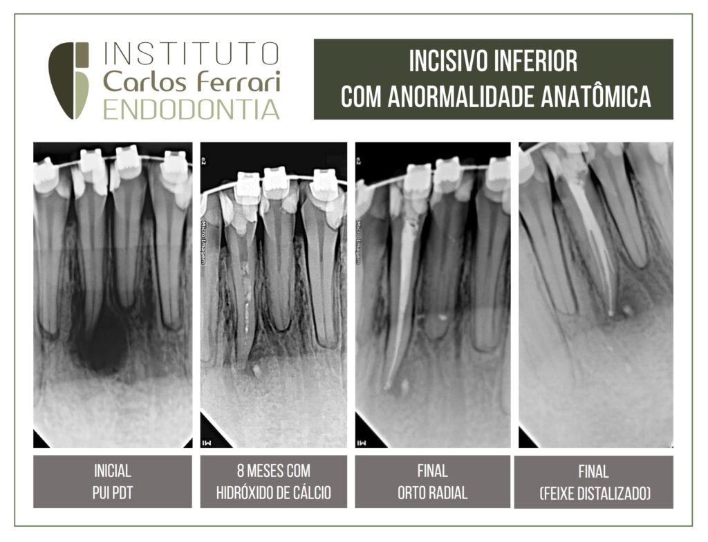 Read more about the article Dental anatomy. Lower incisor abnormality.