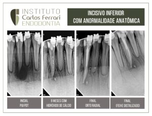 Read more about the article Anatomia dental. Anormalidade no incisivo inferior.