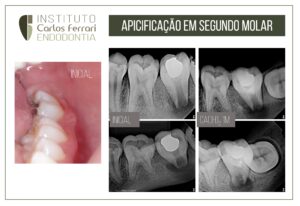 Read more about the article Rizogênese incompleta. Apicificação em 2 molar inferior.
