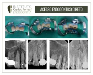 Read more about the article Direct endodontic access surgery.