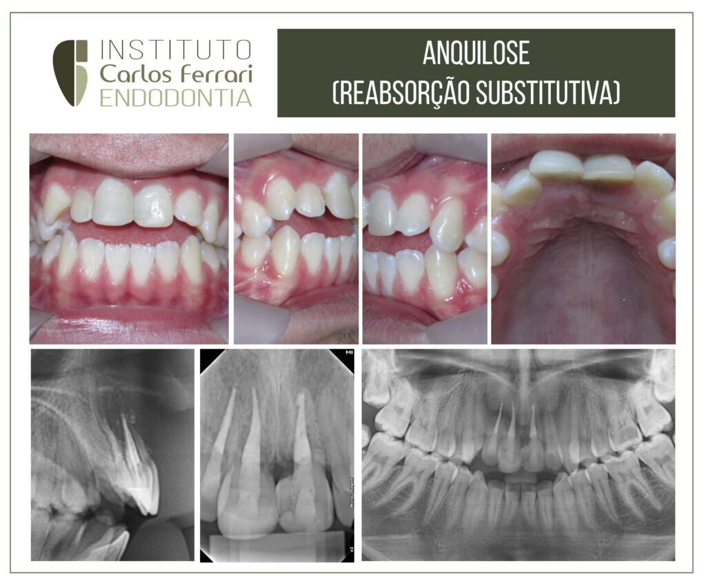 Read more about the article Multiple dental ankylosis in a patient with trauma history.