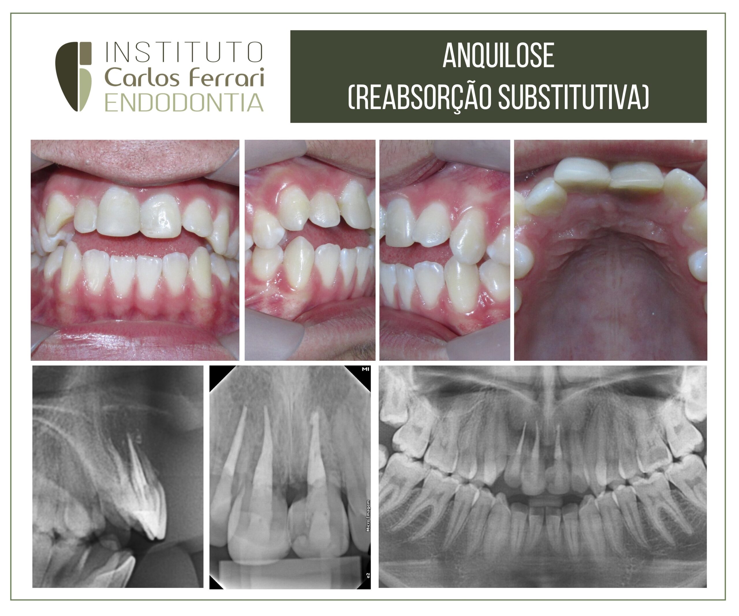 You are currently viewing Anquilose dentária múltipla em paciente com histórico de trauma.